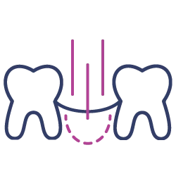 Dental Bone Grafting Icon